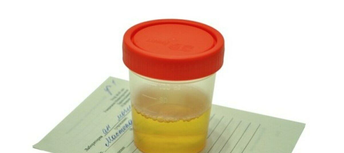 пузыри в моче у ребенка. белые хлопья в моче. хлопья в моче. баночка с мочой. мутная моча.