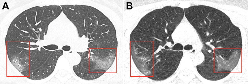 Медики показали снимки поражённых коронавирусом лёгких - Новости Калининграда | Изображение: скриншот сайта журнала Radiology