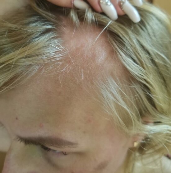 У женщины вырван клок волос | Фото: предоставила пострадавшая