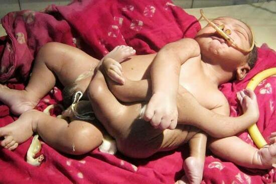 Люди считают его воплощением бога: в Индии родился ребёнок с четырьмя руками и ногами - Новости Калининграда | Фото со страницы Daily Star в Facebook