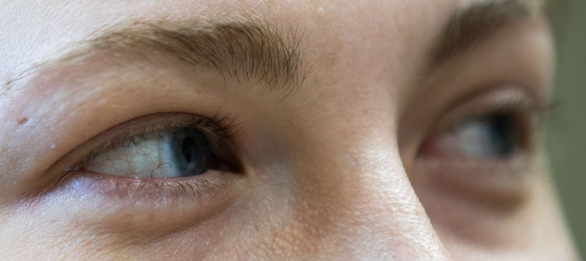Синдром сухого глаза может быть связан с артритом 