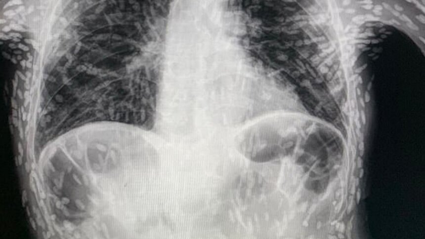 В Бразилии врачи нашли в груди пациента множество личинок паразитического червя (фото)  - Новости Калининграда | Фото: Hospital das Clinicas Botucatu