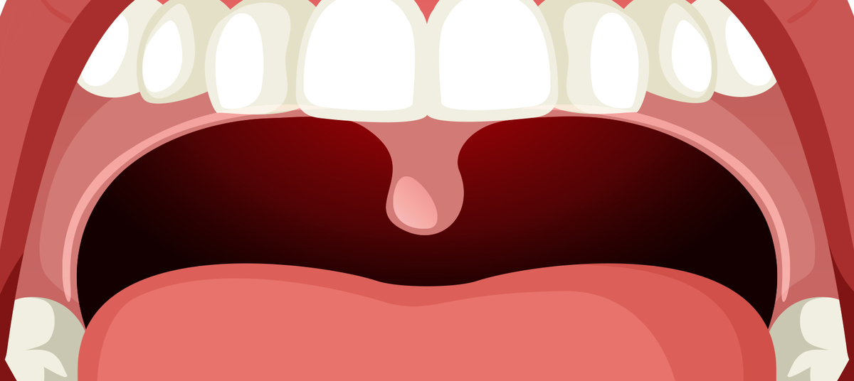 Храп и картавость: как состояние нёбного язычка влияет на здоровье человека