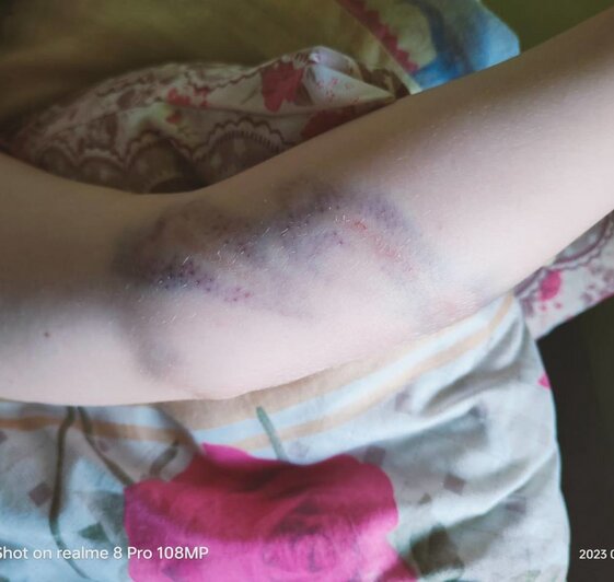 Раны на руках девочки | Фото: очевидец