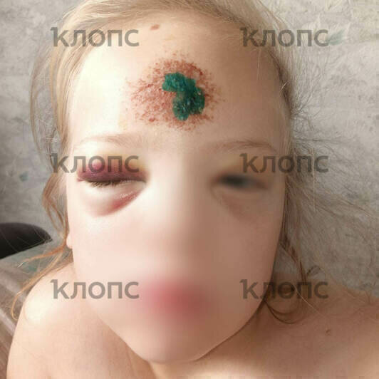 В первый день у ребёнка был разбит лоб, на вторые сутки заплыли глаза, появилась гематома | Фото: мама девочки 