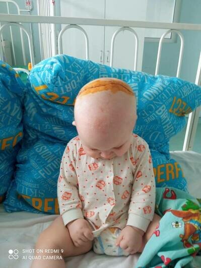 Алексей через три дня после операции на черепе  | Фото: Кристина Калинкина 