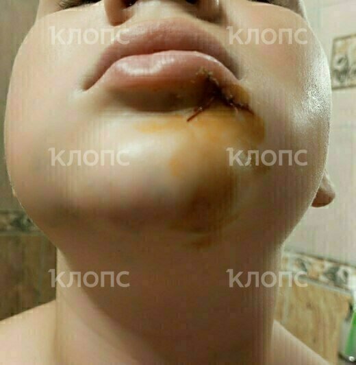 У сына раздуло лицо, разрывы губы и десны, шатаются коренные зубы | Фото: Екатерина