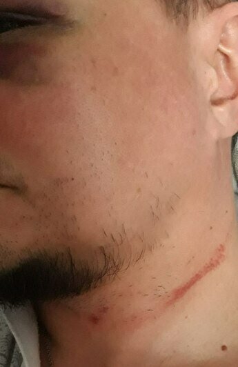 На лице и шее травмы после нападения  | Фото: предоставил пострадавший 