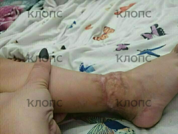 Нога мальчика после операции  | Фото: предоставила мама Сергея