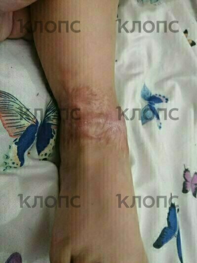 Нога мальчика после операции  | Фото: предоставила мама Сергея