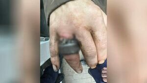 Пилили под наркозом: в Калининграде спасатели освободили палец мужчины от железных колец (видео)