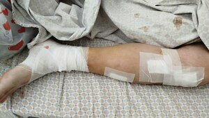 Избитый под Калининградом многодетный отец почти год ждёт решения следствия и пытается восстановить искалеченную ногу   