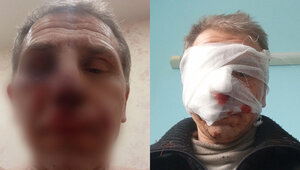 Едва не откусил нос: в Калининграде питбуль набросился на знакомого хозяйки и разорвал ему лицо (фото)   