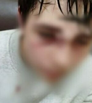 Подросток из посёлка под Калининградом перенёс операцию и оказался в гипсе после драки в школьной раздевалке  